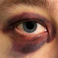 black eye