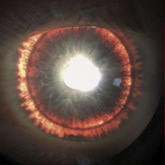 cauterizedeyes