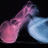 SYNCOPE
