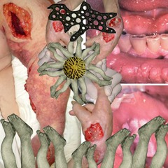 Progressive Lipodystrophy