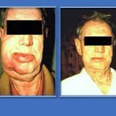 деменция альцгеймеровна