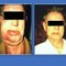 деменция альцгеймеровна