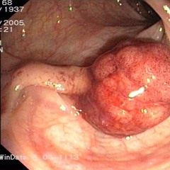 polyp19