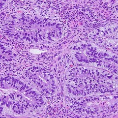 Adenocarcinoma