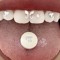 thorazine