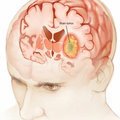 Massive Brain Tumor