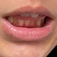 Moldy Teeth
