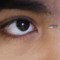 fibroma