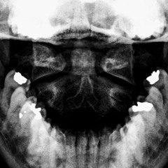 Occult Spine