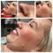 Anus Skin Tag Removal Cream