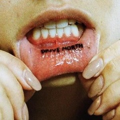 sunburn