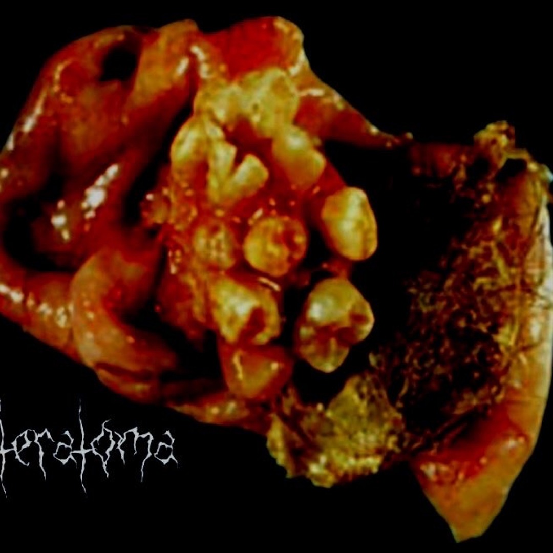Stream teratoma music | Listen to songs, albums, playlists for free on ...