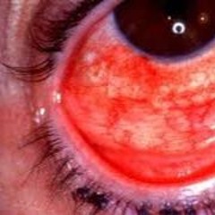 eyeblind