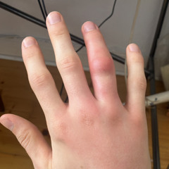 Swollenfuckinghandfrombeesting