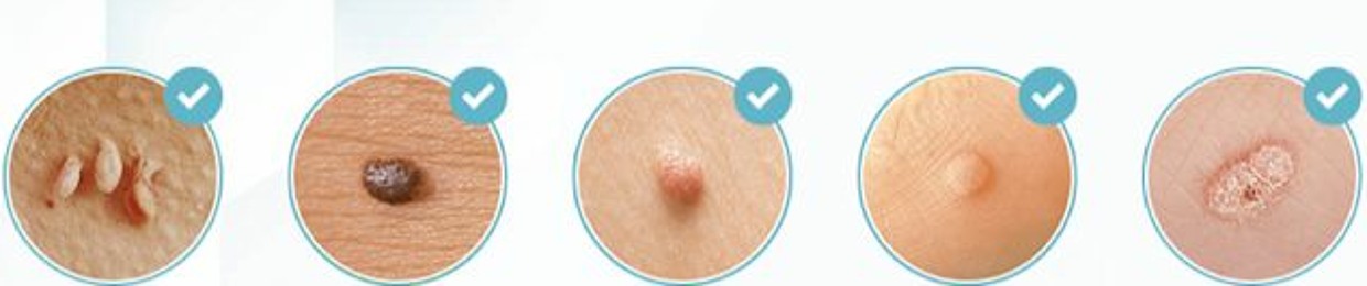Radiantcutisskintagremoverreviews