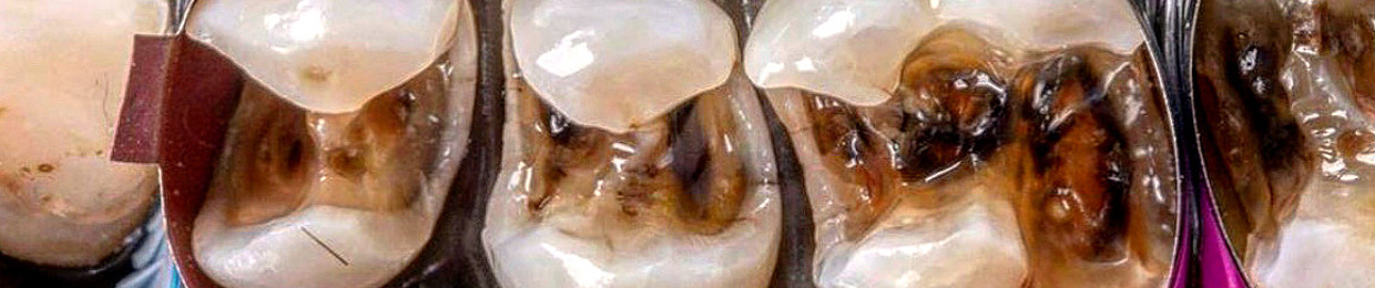 DENTADURA
